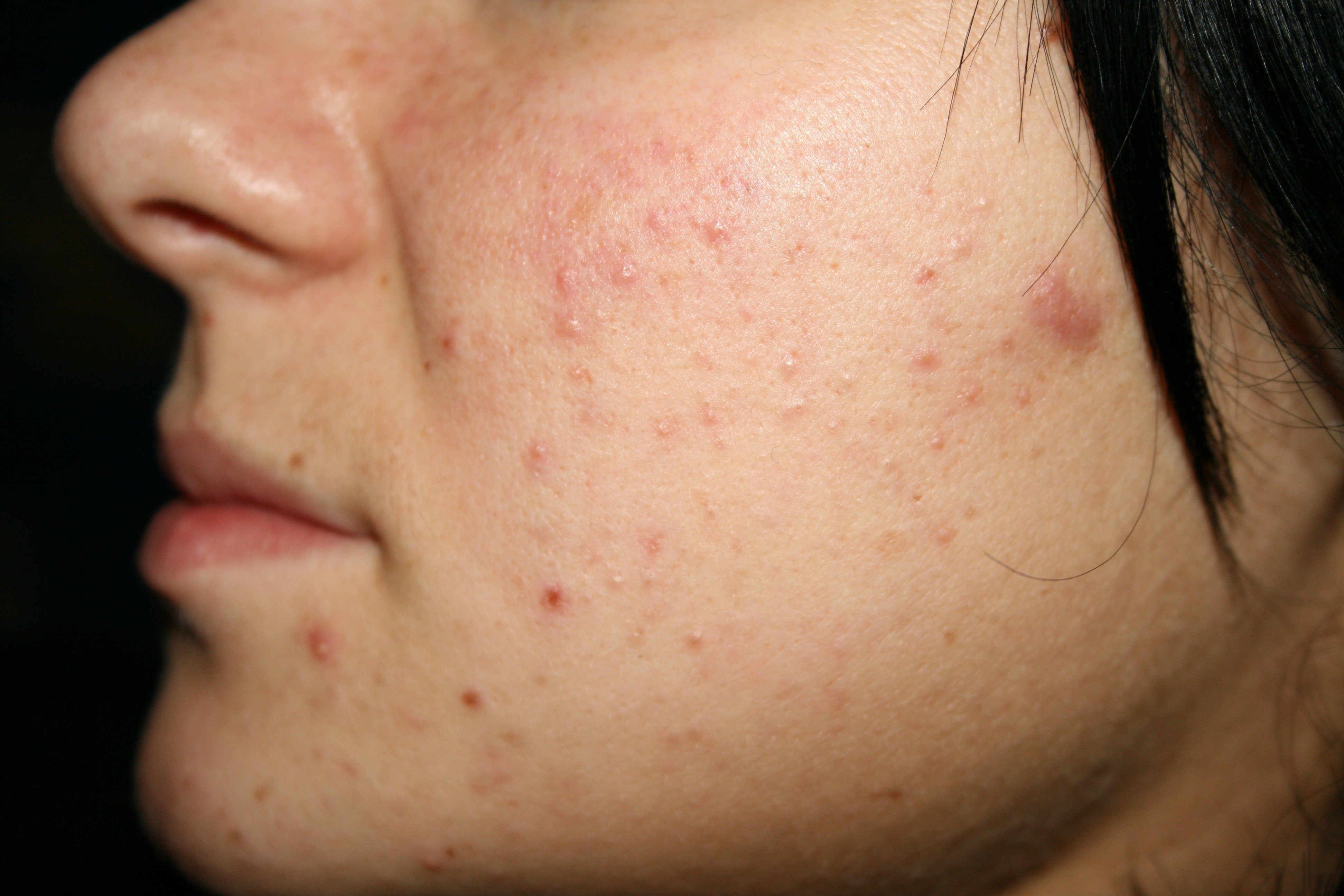 My little black spots: how to get rid of acne without