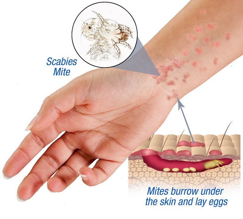 Scabies Pictures: Rash, Skin Infections, Itching, Symptoms ...