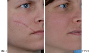 scars removal