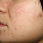 My little black spots: how to get rid of acne without problems and worrying