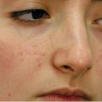 Acne scars