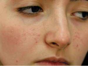 Acne scars