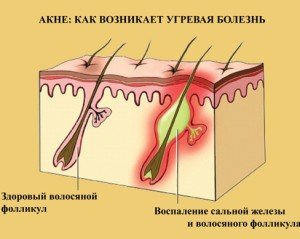 How to prevent acne foto