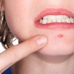 What if acne never exists? How to prevent acne and do not worry in future