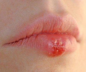swollen lips foto