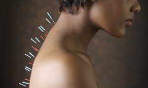 Acupuncture