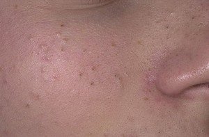 Blackheads 