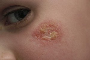 eczema