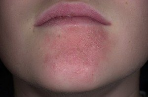 eczema