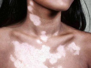 white spots on skin