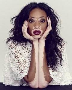 Vitiligo