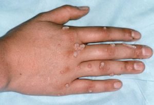 warts on hand