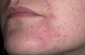 Eczema