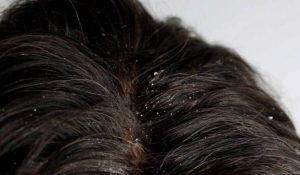 dandruff