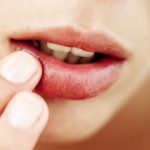 5 Things to do to get rid of angular stomatitis effectively