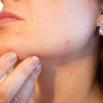 How to Get Rid of Acne: Top-5 Effective Steps